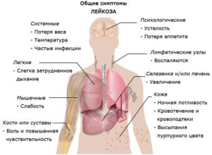 Как начинается рак крови?