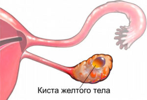 Киста жёлтого тела лечится Дюфастоном?