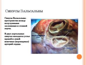 Расширение аорты на уровне синусов Вальсальвы