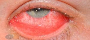 На спайке конъюнктивы глаза воспалительный очаг под слизистой
