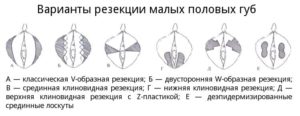 Малые половые губы стали меньше