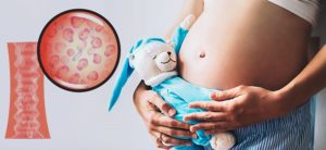 Бактериальный вагиноз и беременность
