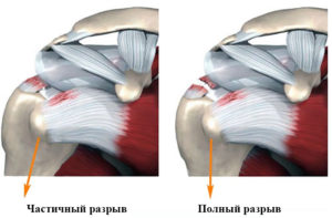 Повреждение сухожилия надостной мышцы