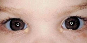 Белые выделения из глаз у ребенка