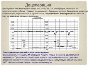 Расшифровка КТГ 8 баллов, много акцелираций и присутствуют децелерации