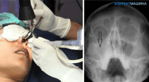 Послеоперационное лечение после удаление кисты в/ч пазухи носа