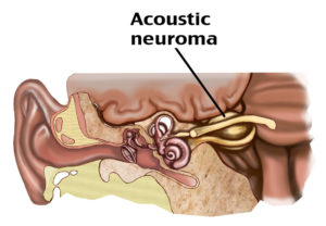 Невринома слухового нерва