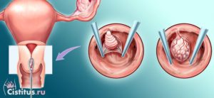 Полип цервикального канала повторно появится снова?