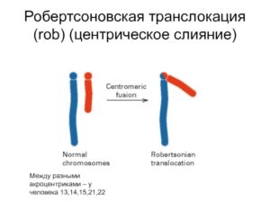 Робертсоновская транслокация 13,14 хромосомы