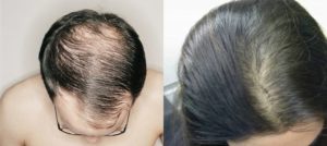 Выпадение волос при низком ферритине