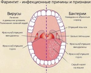 Хронический фарингит. Бактериальный или вирусный?