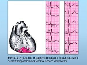 Изменения задне-боковой стенки миокарда неспецифического характера