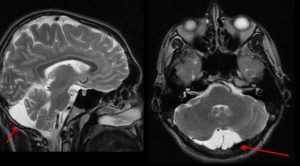 Обнаружили арахноидальную кисту, ретроцеребеллярную