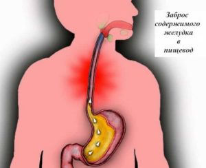 Рефлюкс, отрыжка, изжога, ком в горле, распирание в пищеводе