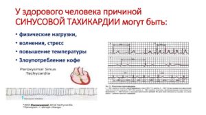 Тахикардия и температура