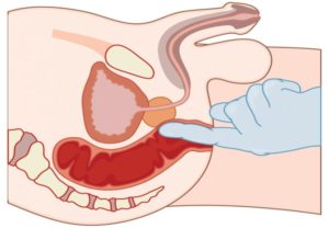 Боль после массажа простаты