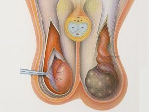 В мошонке левое яичко ниже правого