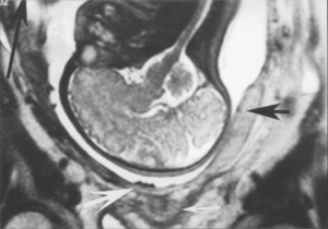 Множественные кисты и толстая плацента на 18 неделе беременности