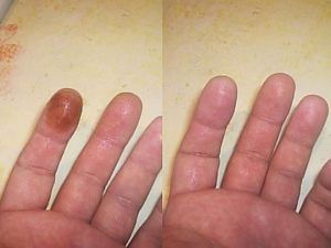 Много марганцовки попало на кожу