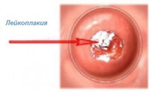 Лейкоплакия шейки матки