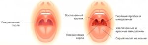 Боль в горле после пневмонии