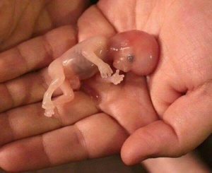 Медикаментозный аборт 10 недель