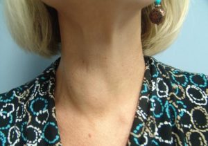 Рост узла щитовидной железы