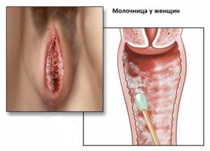 Трещины на малых половых губах