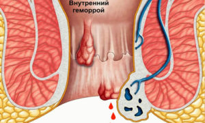 Покалывание в заднем проходе