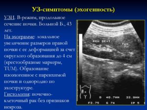 Изоэхогенное образование