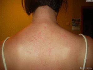 Прыщи и сыпь на спине после массажа