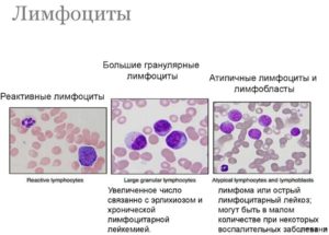 Атипичные лимфоциты в крови