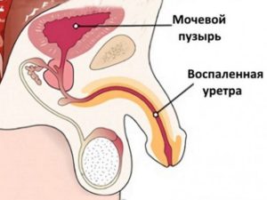 Остатки спермы в мочеиспускательном канале