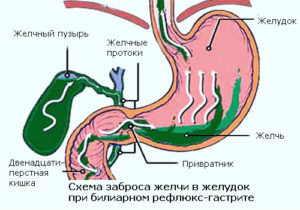 Заброс желчи