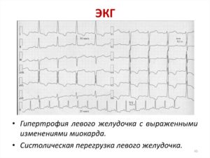 Изменения миокарда левого желудочка