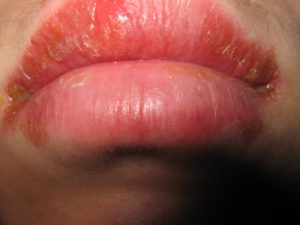 Воспаление верхней губы