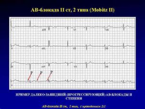 Эпизоды АВ-блокады 2 ст. 2 типа