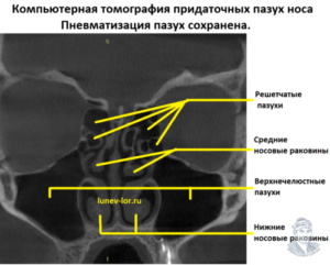 Пневматизация ППН не снижена. ДНП. Носовые ходы сужены